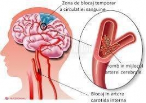 Accidentul vascular cerebral, una dintre cele mai de temut boli