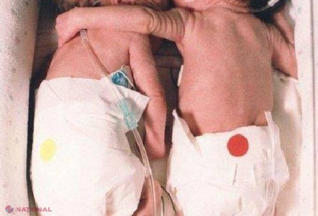 Erau două gemene născute prematur, iar medicii le-au pus în incubatoare separate, dar una dintre ele era în stare gravă! Ce s-a întâmplat când le-au adus împreună în acelaşi incubator te va impresiona