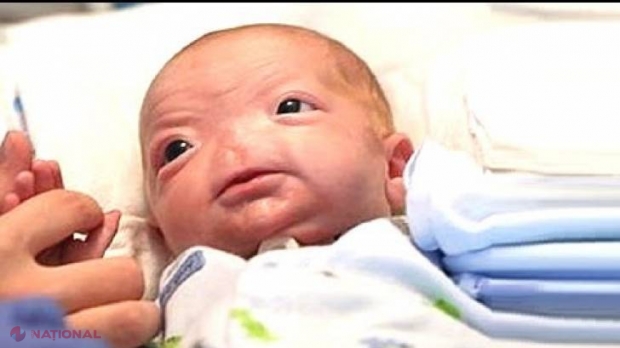 Vă mai amintiți de bebelușul născut fără nas? Ce s-a întâmplat la o lună de la naștere e incredibil 